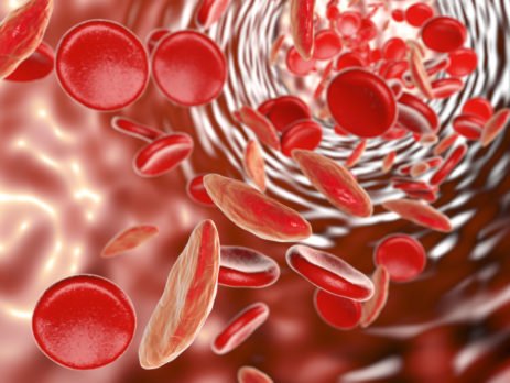 Das Blutbild bei Sichelzell Anämie - eine der zahlreichen Anämie Formen des Menschen.